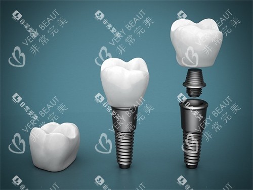种植牙结构展示