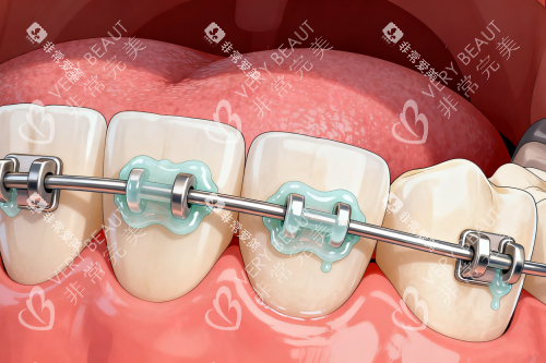 传统牙齿矫正方式展示图 传统牙齿矫正方式展示图