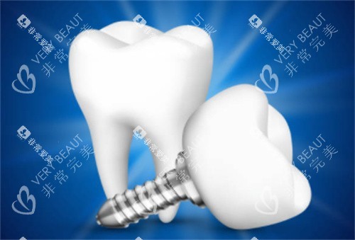2颗种植牙模型图 2颗种植牙模型图