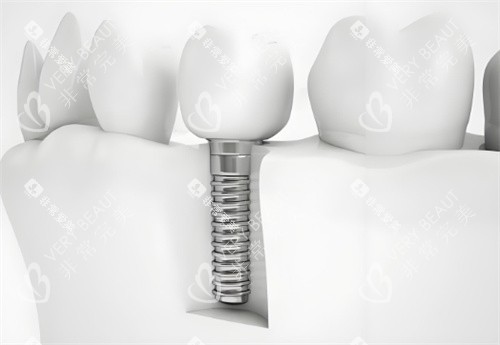 种植牙模型图片 种植牙模型图片
