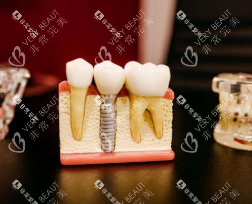 种植牙模具图 种植牙模具图