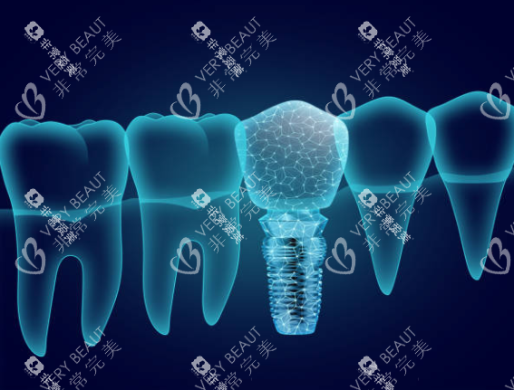 种植牙模型图卡通图