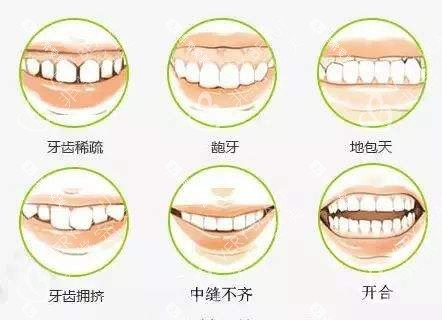 牙齿矫正不同的适应症