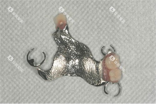 多颗可摘局部义齿实物图